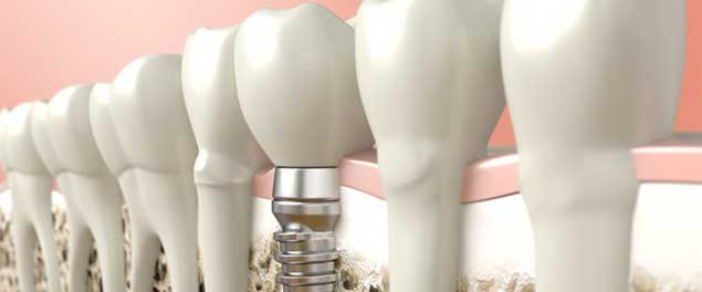 базальная имплантация зубов в Уфе