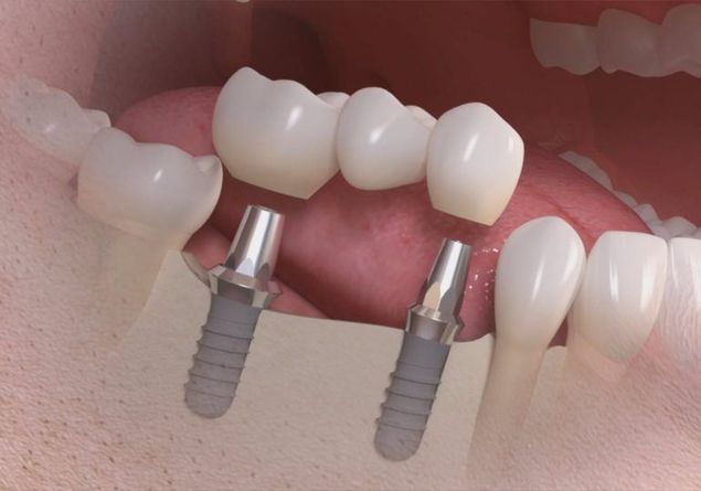 базальная имплантация зубов