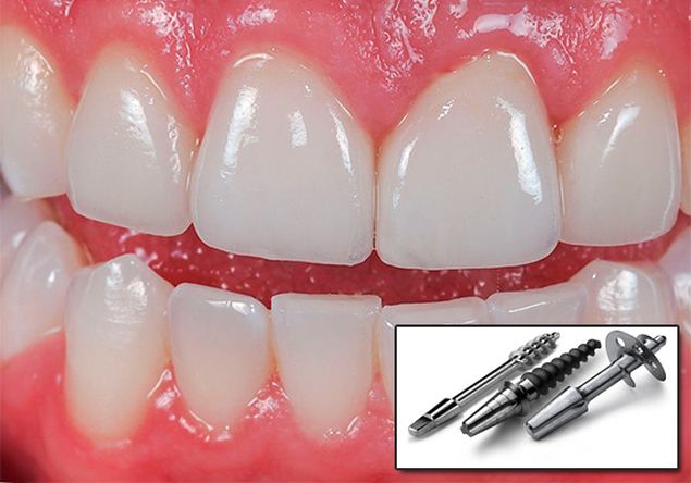 базальная имплантация зубов