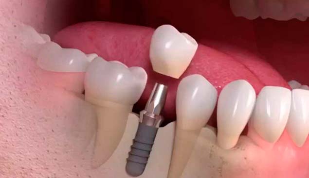 срок службы зубных имплантов