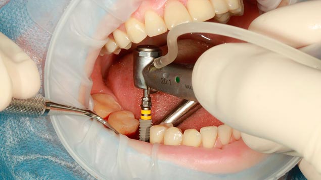 одноэтапная имплантация зубов в Пензе