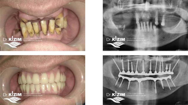 базальная имплантация зубов в Люберцах