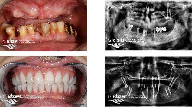базальная имплантация зубов в Мытищах