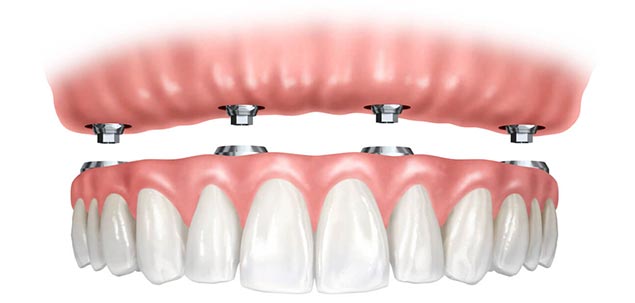 базальная имплантация зубов цена