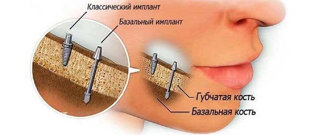 базальная имплантация зубов в Красногорске
