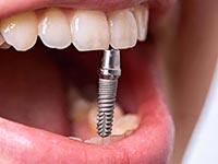 базальная имплантация зубов в Пензе