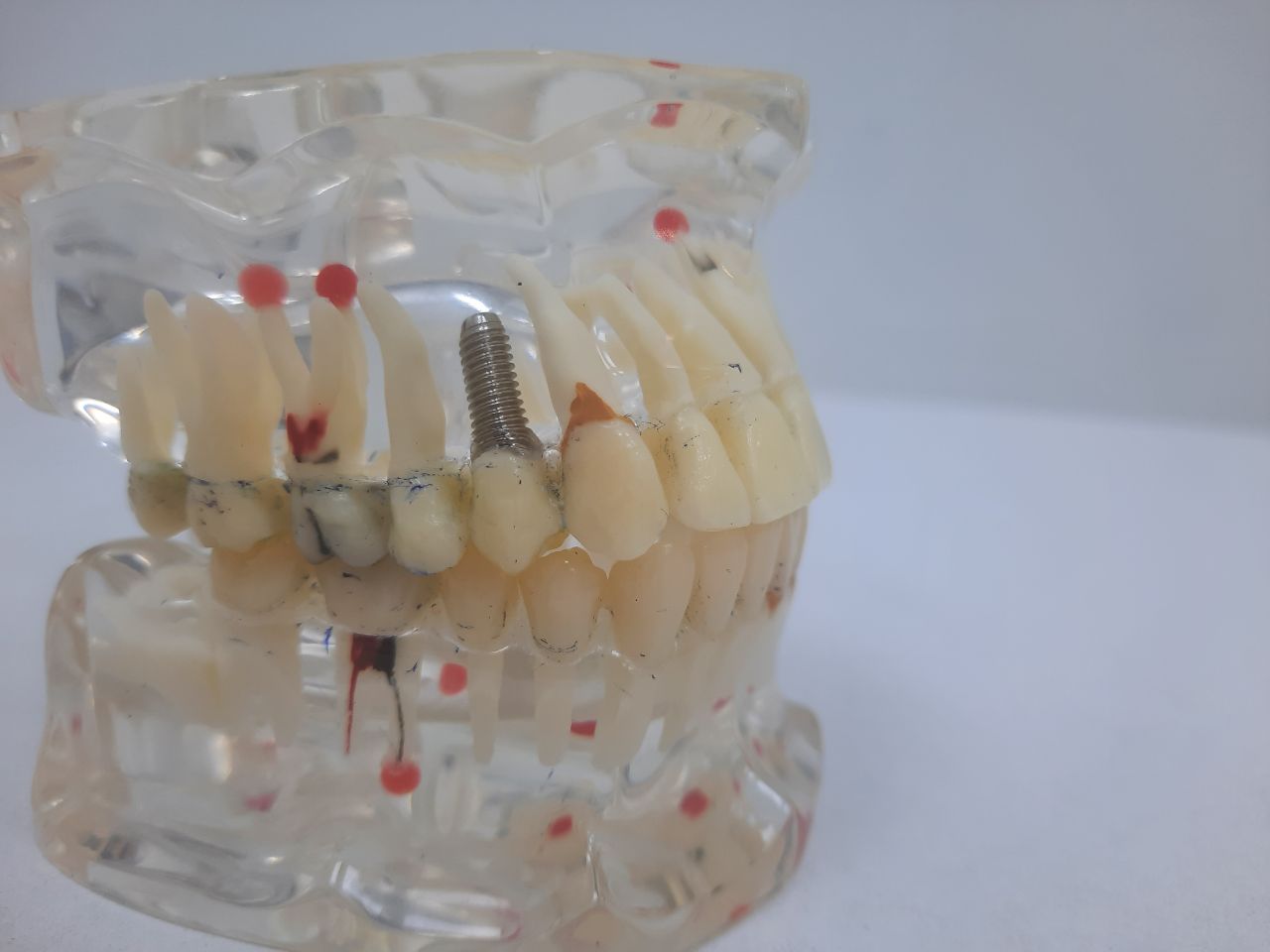 имплантация зубов с коронкой